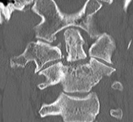 Coronal CT